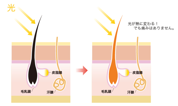 ■光脱毛の原理